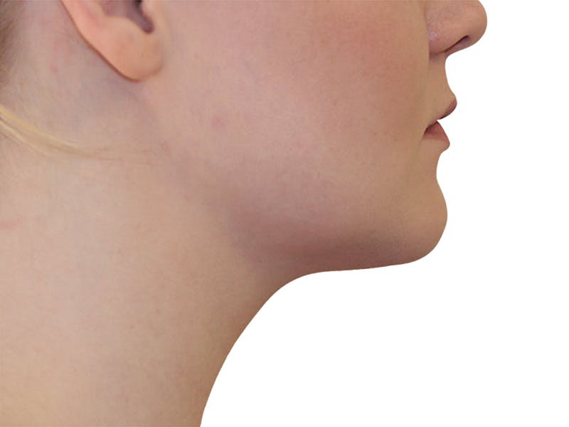 Neck Liposuction Before & After Gallery - Patient 142839 - Image 4