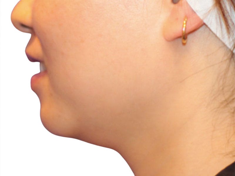 Neck Liposuction Before & After Gallery - Patient 197780 - Image 1