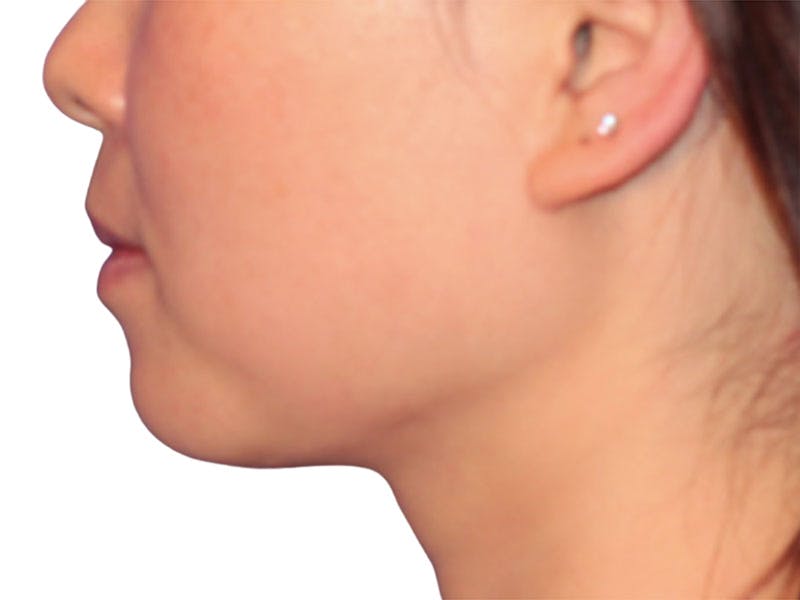 Neck Liposuction Before & After Gallery - Patient 197780 - Image 2