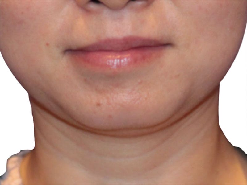 Neck Liposuction Before & After Gallery - Patient 197780 - Image 3