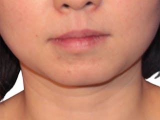 Neck Liposuction Before & After Gallery - Patient 197780 - Image 4