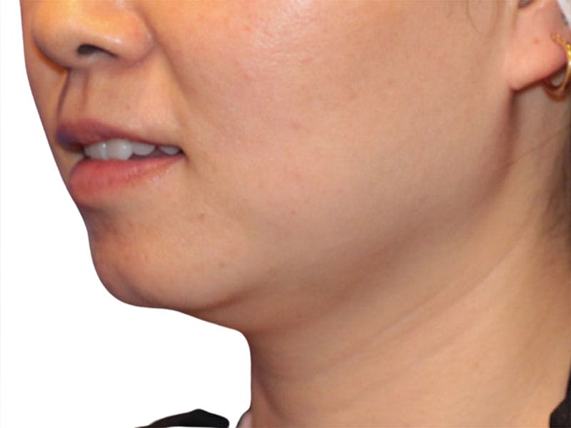 Neck Liposuction Before & After Gallery - Patient 197780 - Image 5