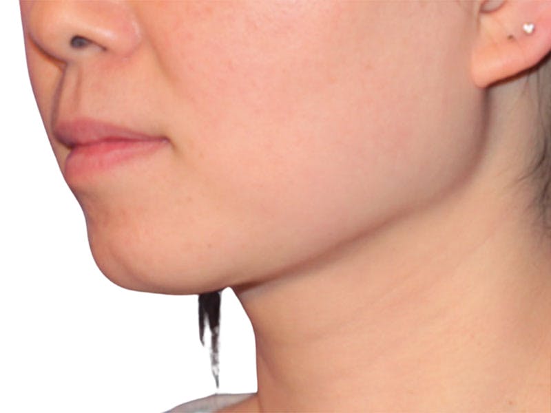 Neck Liposuction Before & After Gallery - Patient 197780 - Image 6