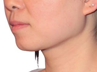 Neck Liposuction Before & After Gallery - Patient 197780 - Image 6