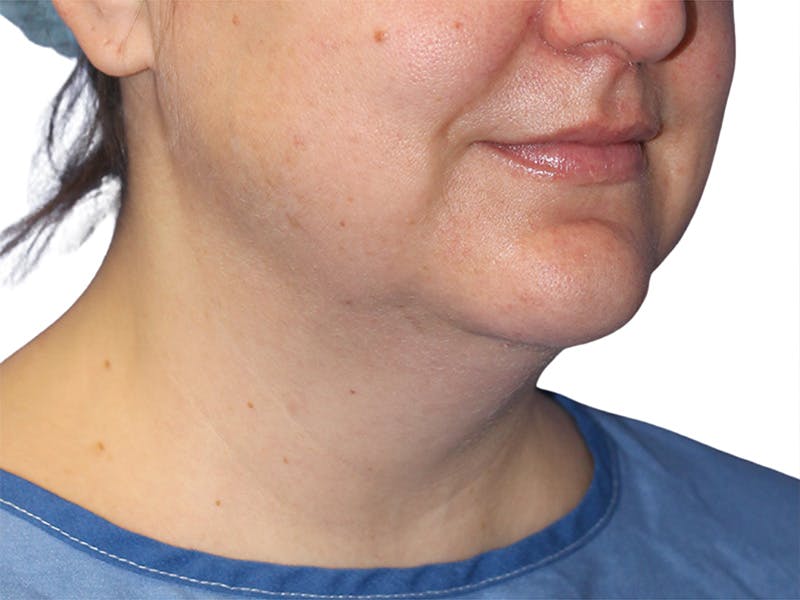 Neck Liposuction Before & After Gallery - Patient 609620 - Image 1