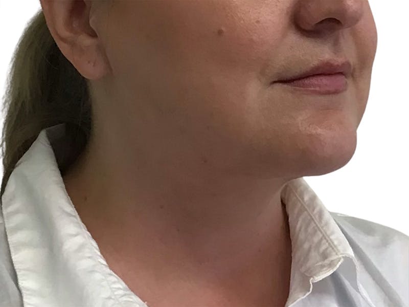 Neck Liposuction Before & After Gallery - Patient 609620 - Image 2