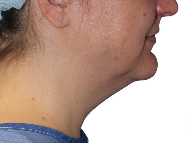 Neck Liposuction Before & After Gallery - Patient 609620 - Image 3