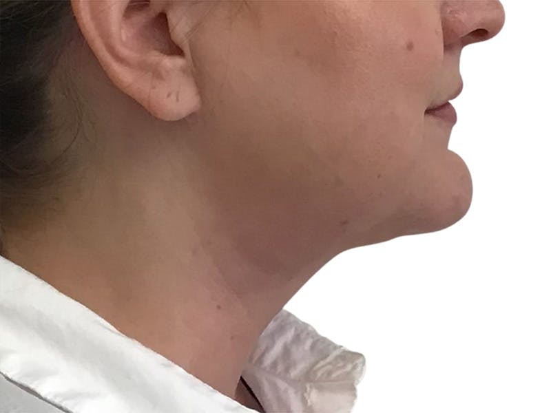 Neck Liposuction Before & After Gallery - Patient 609620 - Image 4