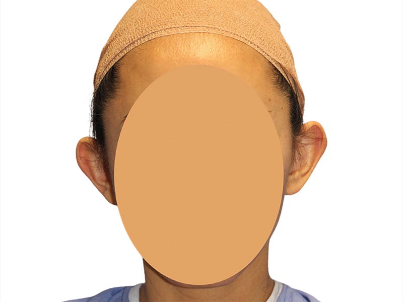 Ear Surgery Before & After Gallery - Patient 502651 - Image 1