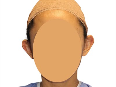 Ear Surgery Before & After Gallery - Patient 502651 - Image 1