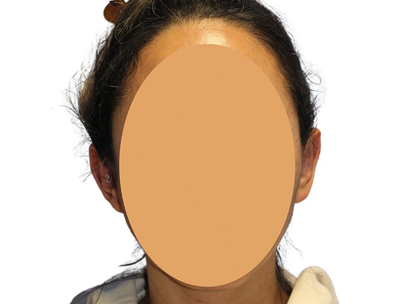 Ear Surgery Before & After Gallery - Patient 502651 - Image 2