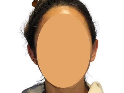 Ear Surgery Before & After Gallery - Patient 502651 - Image 2