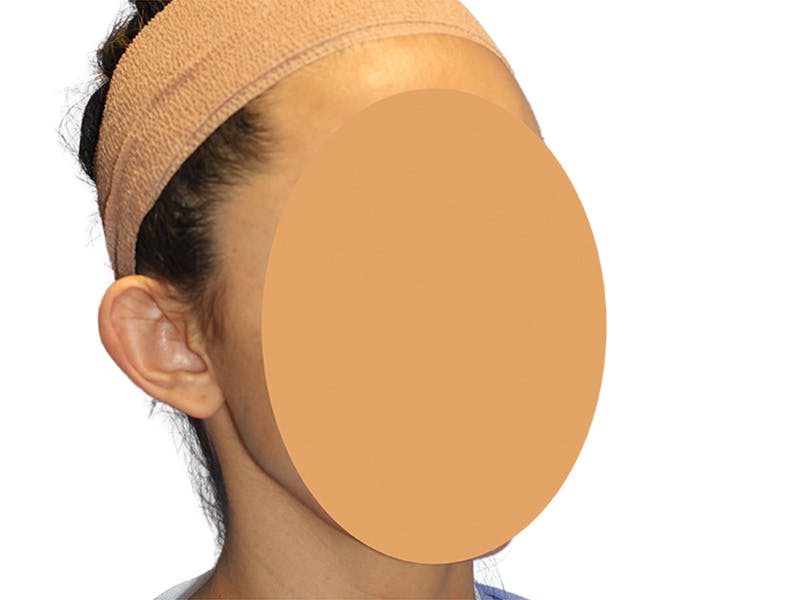 Ear Surgery Before & After Gallery - Patient 502651 - Image 3