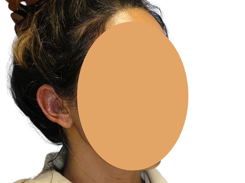 Ear Surgery Before & After Gallery - Patient 502651 - Image 4