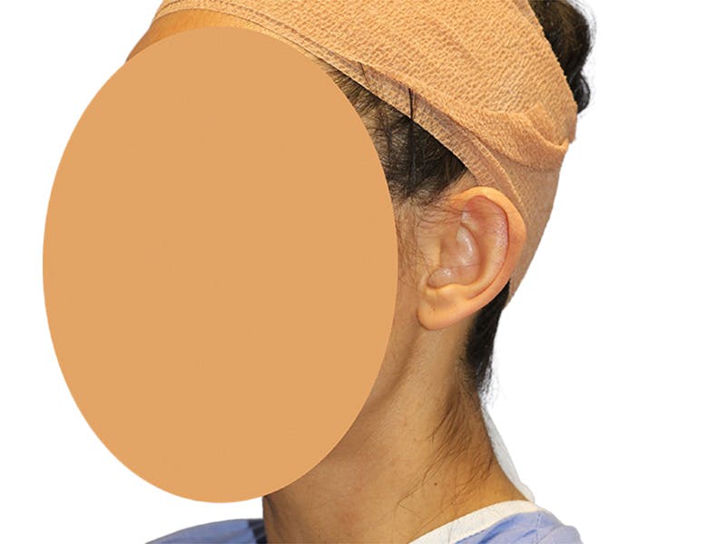 Ear Surgery Before & After Gallery - Patient 502651 - Image 5