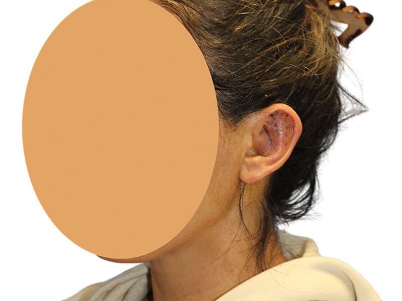 Ear Surgery Before & After Gallery - Patient 502651 - Image 6
