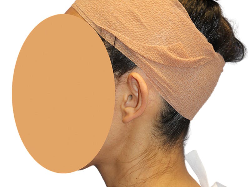 Ear Surgery Before & After Gallery - Patient 502651 - Image 7