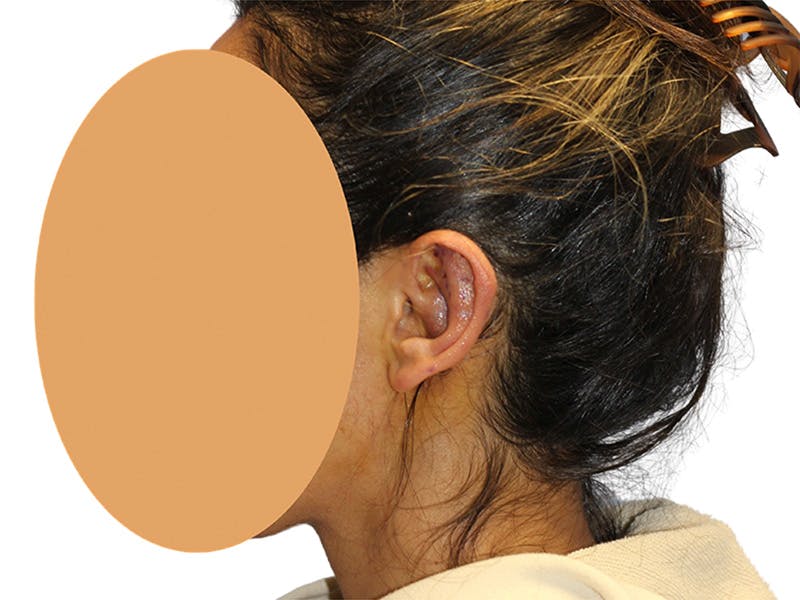 Ear Surgery Before & After Gallery - Patient 502651 - Image 8