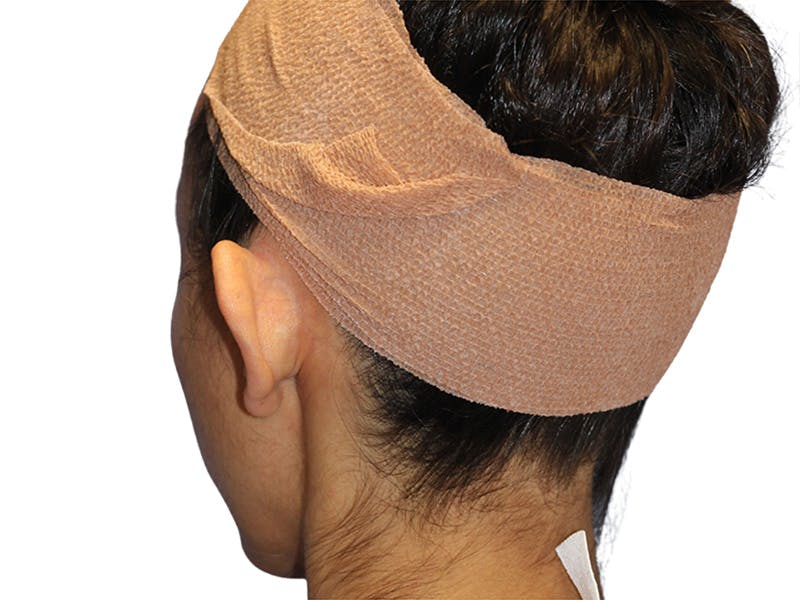 Ear Surgery Before & After Gallery - Patient 502651 - Image 9