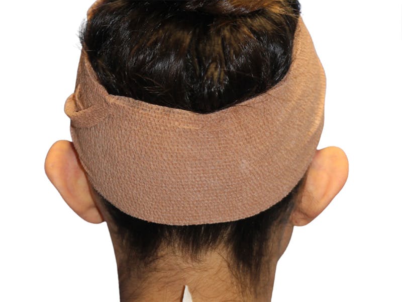 Ear Surgery Before & After Gallery - Patient 502651 - Image 11