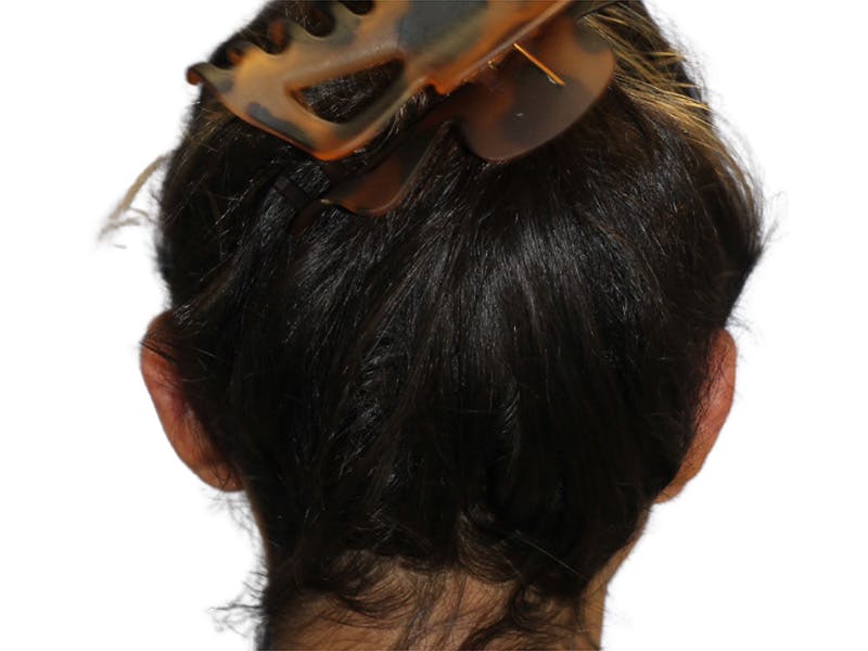 Ear Surgery Before & After Gallery - Patient 502651 - Image 12