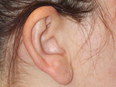 Ear Surgery Before & After Gallery - Patient 226577 - Image 1