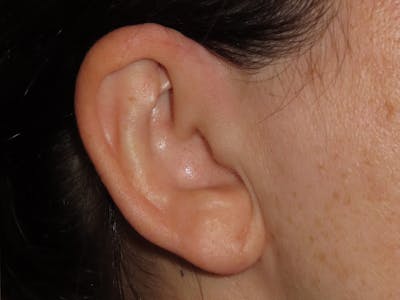 Ear Surgery Before & After Gallery - Patient 226577 - Image 2