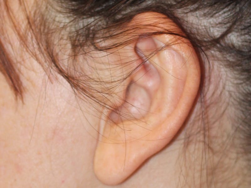 Ear Surgery Before & After Gallery - Patient 226577 - Image 3