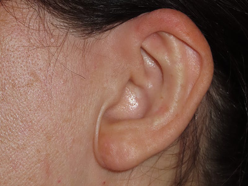 Ear Surgery Before & After Gallery - Patient 226577 - Image 4