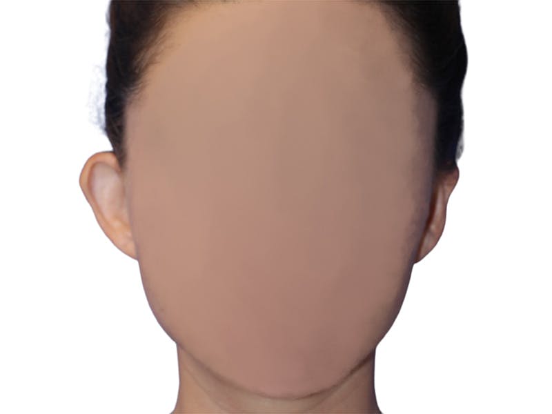 Ear Surgery Before & After Gallery - Patient 181353 - Image 1