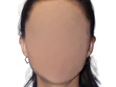 Ear Surgery Before & After Gallery - Patient 181353 - Image 2