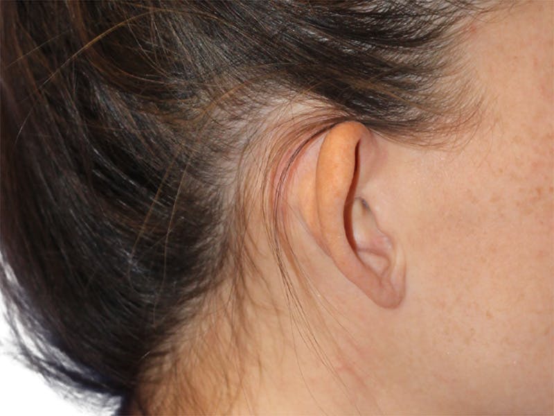 Ear Surgery Before & After Gallery - Patient 181353 - Image 3