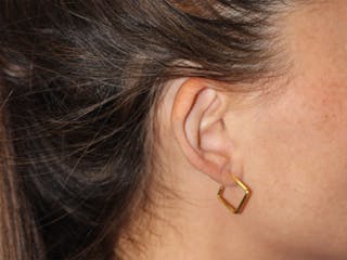 Ear Surgery Before & After Gallery - Patient 181353 - Image 4