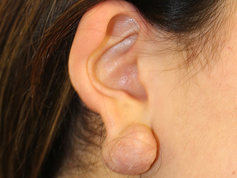 Ear Surgery Before & After Gallery - Patient 338175 - Image 1