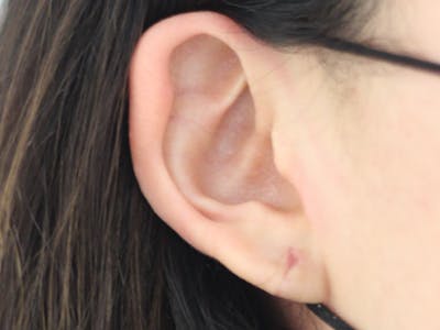 Ear Surgery Before & After Gallery - Patient 338175 - Image 2