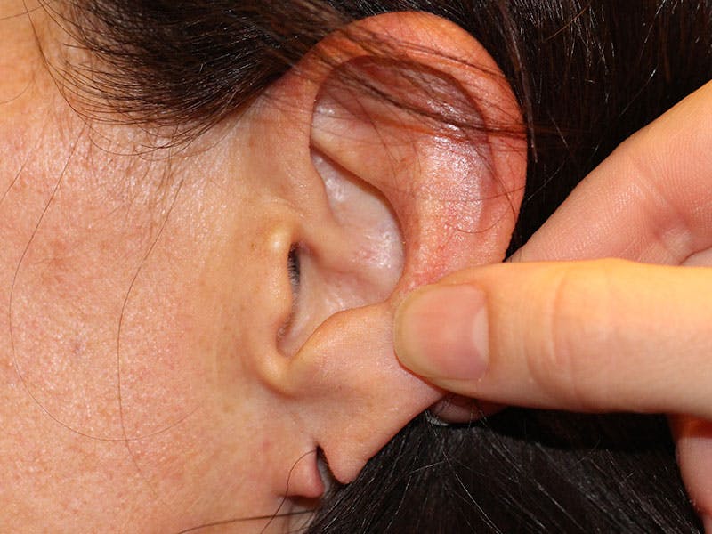 Ear Surgery Before & After Gallery - Patient 413002 - Image 1
