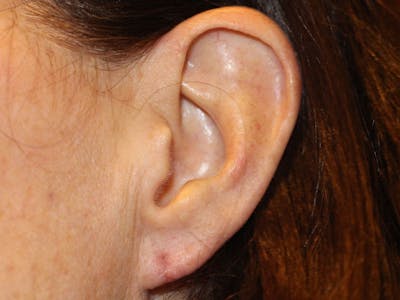 Ear Surgery Before & After Gallery - Patient 413002 - Image 2