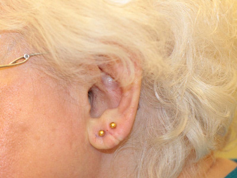 Ear Surgery Before & After Gallery - Patient 162248 - Image 2