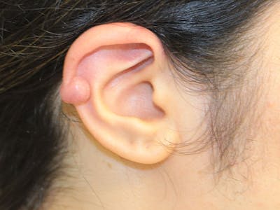 Ear Surgery Before & After Gallery - Patient 191428 - Image 1