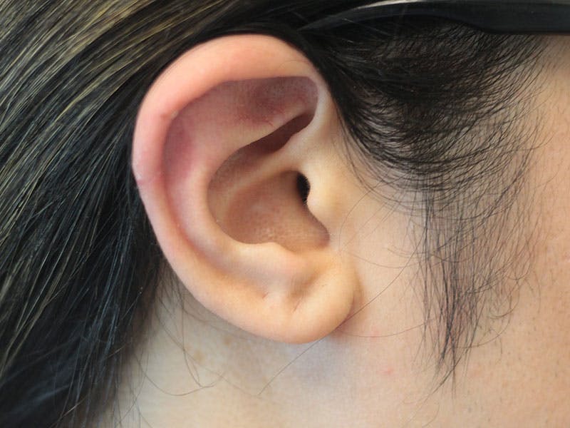 Ear Surgery Before & After Gallery - Patient 191428 - Image 2