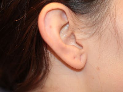 Ear Surgery Before & After Gallery - Patient 586750 - Image 1