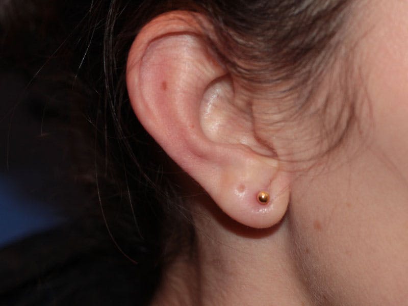 Ear Surgery Before & After Gallery - Patient 586750 - Image 2