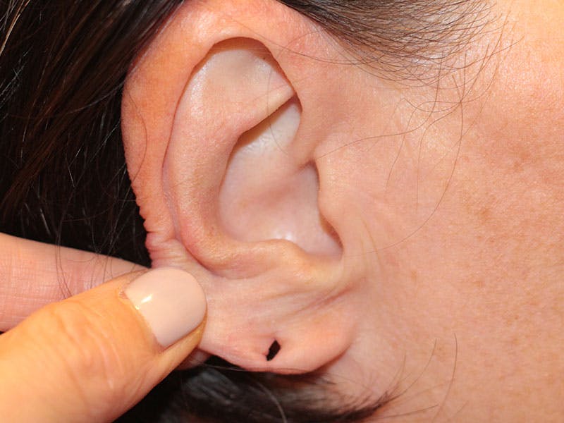 Ear Surgery Before & After Gallery - Patient 192266 - Image 1