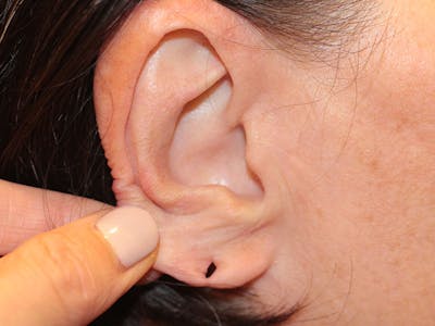 Ear Surgery Before & After Gallery - Patient 192266 - Image 1