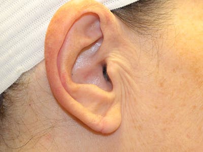 Ear Surgery Before & After Gallery - Patient 192266 - Image 2