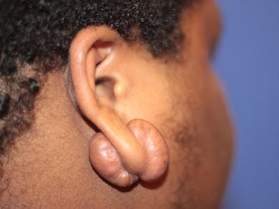 Ear Surgery Before & After Gallery - Patient 199193 - Image 1