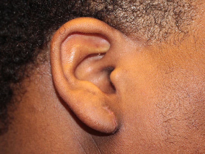Ear Surgery Before & After Gallery - Patient 199193 - Image 2
