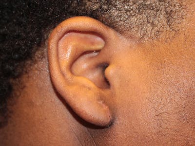 Ear Surgery Before & After Gallery - Patient 199193 - Image 2