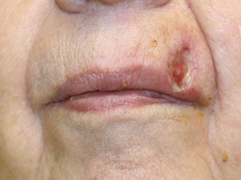 Facial Reconstruction Before & After Gallery - Patient 899671 - Image 1