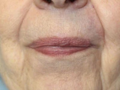 Facial Reconstruction Before & After Gallery - Patient 899671 - Image 2